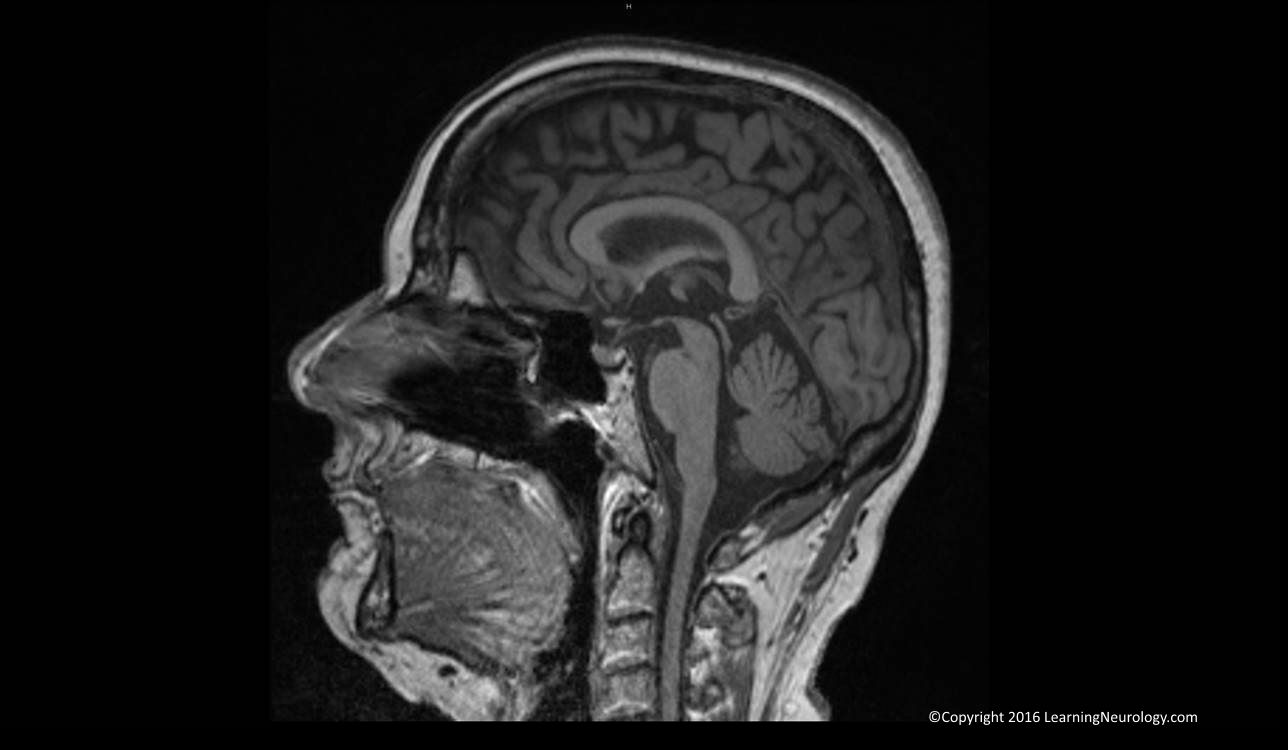 Approach to MRI brain | LearningNeurology.com