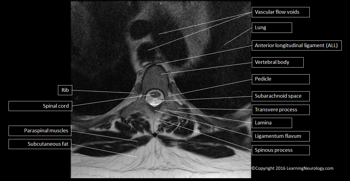 Cervical Spine MRI Axial View