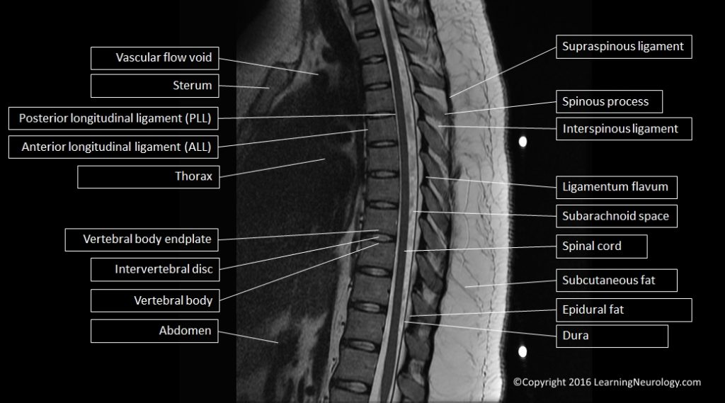 Approach to MRI Spine | LearningNeurology.com
